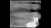 (15.) Photograph of fractured right lateral incisor taken with a smartphone and an EALS device during patient presentation for emergency treatment shown with accompanying radiograph.