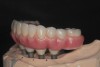 Final full-arch CAD/CAM telescopic prosthesis with layered enamel and pink tissue porcelain.