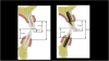 Fig 1. Comparison between the natural dentition assembly and the dental implant-tooth restoration assembly.