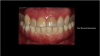 Fig 13. Final screw-retained zirconia restoration.