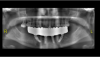 Fig 14. Panoramic CBCT image.