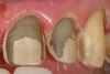 Figure 16  Close-up of an all-ceramic restoration preparation design demonstrating dentin exposure of more than 50%, less than 50% enamel remaining for bonding, and margins with 30% enamel periphery.