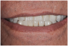 Fig 2. Potential “All-on-4” patient with terminal dentition who was unhappy with his smile esthetics.
