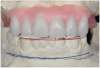 Fig 4. Diagnostic wax-up performed after model surgery simulating maxillary tooth extraction. Note that inferior repositioning of the incisal plane helped create the 15 mm to 17 mm inter-occlusal space needed for the maxillary All-on-4 provisional restoration.