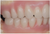 Fig 6. Completed diagnostic wax-up for maxillary and mandibular All-on-4 full-arch rehabilitation.