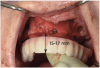 Fig 8. Provisional prosthesis guide is used as a surgical guide to verify adequate bone reduction and leveling with the incisal and occlusal planes of the prosthesis.