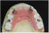 Fig 16. Indirect denture conversion—The indexed provisional prosthesis is modified for passive attachment of the posterior titanium cylinders to the prosthesis using heat-cured acrylic under pressure. This process is repeated for the anterior indexed implants, leading to a higher quality provisional with increased strength.