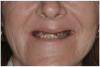 Fig 17. Pre-treatment smile of patient with terminal dentition.