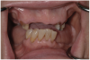 Fig 18. The patient’s intraoral condition.