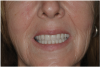 Fig 19. Patient smile shown 3 years post-treatment.