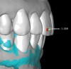 Fig 9. Scans used to mock-up desired restorative result using modeling software. The teal-green areas represent the current tooth form, and the white areas show the desired or digital wax-up. A reduction of 1.009 mm was required prior to preparation, making endodontic treatment likely if orthodontic treatment is not considered.