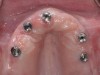 Fig 4. Four weeks after treatment, the patient presented with healthy peri-implant tissues.