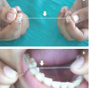 Figure 1. Knotted Floss Technique. (A) Make a simple knot (arrow) in the middle of the length of floss. (B) Floss is inserted between teeth (non-knotted part) and then knotted area (arrow) is allowed to slide through embrasure.