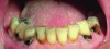 Fig 1. Patient with rampant buccal/cervical caries due to long-term use of anticholinergic drugs.