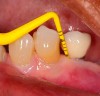 Figure 2. Clinical probing depth: gentle probing around dental implant.