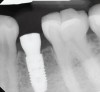 Figure 4. Radiograph at the time of implant placement.