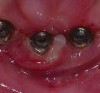 Figure 6. Peri-implantitis; note suppuration in peri-implant soft tissue.
