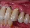 Figure 7. Location of the free gingival margin: soft-tissue recession surrounding implant.