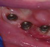 Figure 8. Peri-implantitis; note lack of keratinized gingiva surrounding implant.
