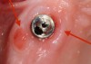 Figure 10. Peri-implant mucositis.