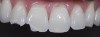(10.) The palatal wall was initially built with a bleach LE shade to mimic the incisal halo before the final facial layer was placed.
