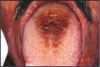 Figure 1 – Hairy Tongue (Black) Used with Permission, www.docspiller.com24
