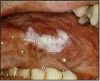 Figure 2 – Leukoplakia, Used with Permission, www.docspiller.com24