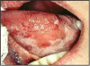 Figure 3 – Squamous Cell Carcinoma of the Tongue, Used with Permission, www.docspiller.com24
