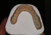 Fig 5. Occlusal view of completed zirconia with porcelain application on teeth Nos. 29, 30, and 31.