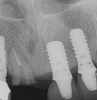 Fig 7. Radiograph showing the patient’s multiple implant restorations.