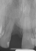 Fig 16. Preoperative periapical radiograph on the day of surgery.