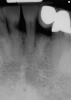 Fig 30. Preoperative periapical radiograph.