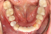 Fig 45. Occlusal view of seated PMMA provisionals.