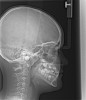 (15.) Cephalometric evaluation demonstrates significant tonsillar blockage of the airway and bimaxillary retursion.