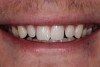 Preoperative view of a patient unhappy with the esthetics of his smile.