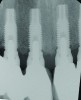 Fig 1 through Fig 6. Periapical radiographs of a 52-year-old man who received a fixed porcelain-fused-to-metal reconstruction supported by abutments attached to externally hexed dental implants. Fig 1 through Fig 3 are at initial prosthesis placement: maxillary right (Fig 1), textured surfaced threaded titanium implants at site Nos. 2, 4, and 6; maxillary anterior (Fig 2), implants at site Nos. 7 through 9; maxillary left (Fig 3), implants at site Nos. 12 and 14. Fig 4 through Fig 6 are 10 years post-insertion of the prosthesis: maxillary right (Fig 4), maxillary anterior (Fig 5), and maxillary left (Fig 6). Note minimal to no bone loss radiographically around the implants 10 years post-insertion of prosthesis.
