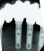 Fig 7 through Fig 14. Periapical radiographs of a 62-year-old woman who received a fixed porcelain-fused-to-metal reconstruction supported by abutments by internally connected dental implants. Fig 7 through Fig 10 are at initial prosthesis placement: mandibular site Nos. 30 and 29 (Fig 7); mandibular site Nos. 26, 25, and 23 (Fig 8); mandibular site Nos. 23 and 21 (Fig 9); mandibular site Nos. 21 through 19 (Fig 10). Fig 11 through Fig 14 are 11 years later (2013) and show excellent preservation of the vertical bone levels around the implants: mandibular site Nos. 30 and 29 (Fig 11); mandibular site Nos. 26 and 25 (Fig 12); mandibular site Nos. 25 and 23 (Fig 13); mandibular site Nos. 20 and 19 (Fig 14). It is interesting to note that in the mandibular right posterior quadrant there is a matched pair, ie, an external hex dental implant (No. 30) adjacent to an internally connected dental implant (No. 29). The bone levels around each of these designs are well-preserved at the 11-year follow-up.