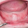 (15.) Recurrent generalized sore spots in a denture patient with poor nutrition.