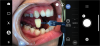 Fig 3. Manual adjustment mode can aid intraoral photography, but it requires a focused external light source.