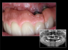 Fig 14. Specialist referrals can also be aided by clear photographs. In this case, an image captured using COCO Lux shows the exposure of implant threads and ulcerations under the prosthesis at 2 years.