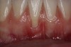 Fig 1. Preoperative clinical view, mandibular central incisor.