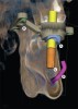 CBCT scan with integrated CAD/CAM virtual tooth design (A) and mapped inferior alveolar nerve (B) to aid in proper implant planning (C, virtually planned endosseous implant); image also shows a reference body with fiducial markers (D) for chairside surgical guide fabrication.