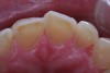 (6.) A common form of gastric erosion results from regurgitation, and presents with prominent involvement of the maxillary anterior lingual surfaces.