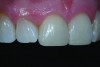 Fig 7. Postoperative view of the direct composite restorations that, although minimally invasive, created a dramatic improvement in the appearance of the patient