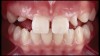 (12. and 13.) Intraoral photographs taken with a smartphone and an EALS device for orthodontic evaluation.
