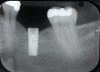 Fig 9. Radiograph depicting fractured screw inside of the implant.