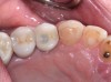 Fig 17. Open proximal contact between implant and adjacent tooth 3 years post insertion.