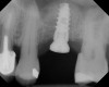 Fig 15. Radiograph of implant No. 14 with sinus augmentation, day of placement. The floor of the sinus has been raised about 7 mm to 8 mm.
