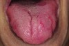 Fig 5. Fissured tongue.