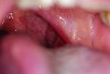 Fig 9. Case 2 clinical photograph showing the
large size of the patient’s tonsils.